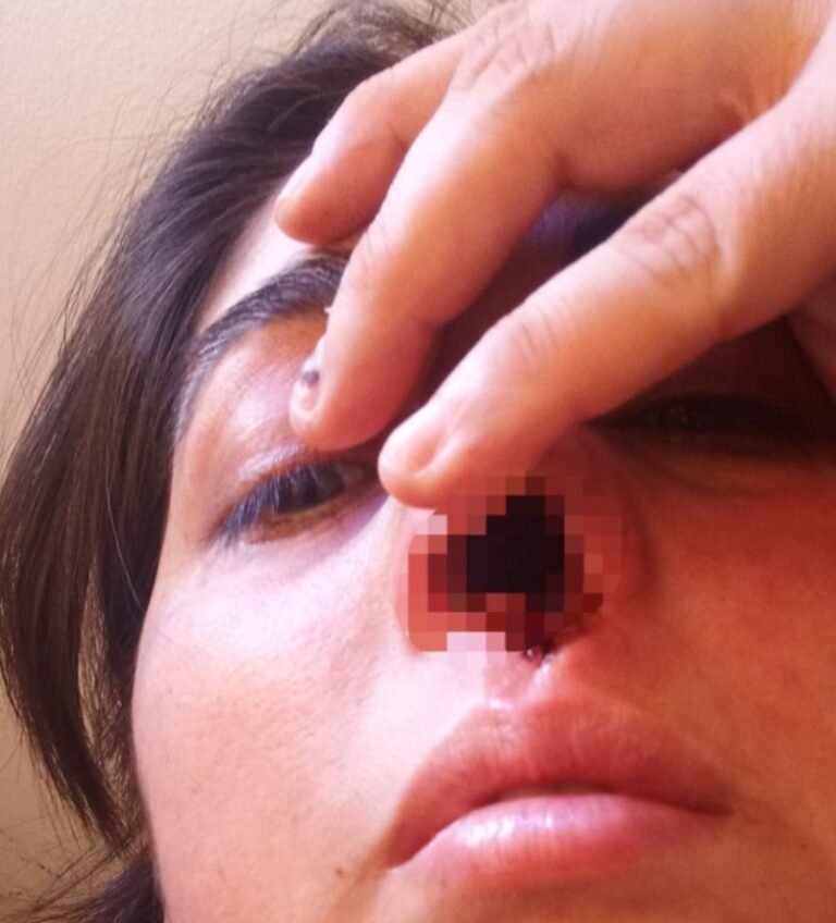 La hisoparon mal, se le infectó y perdió el cartílago