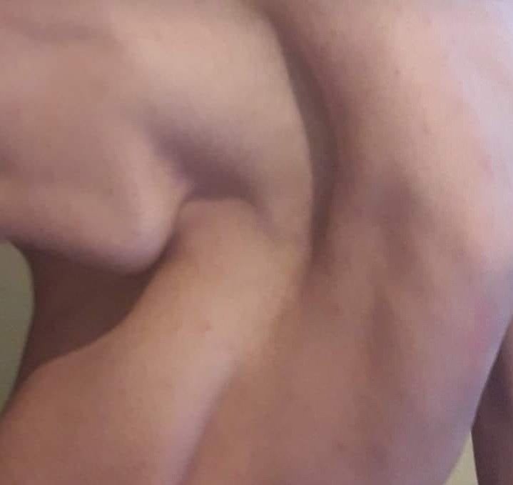 Sufre de una desviación de la columna y su salud está en riesgo