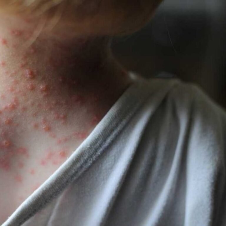 Detectaron partículas compatibles con la viruela del mono en el primer caso sospechoso