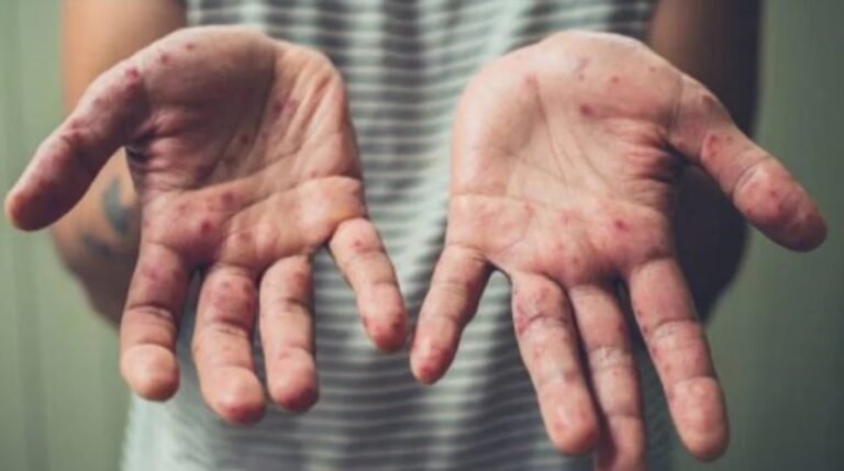 Confirman el segundo caso positivo de Viruela del mono en Santa Cruz