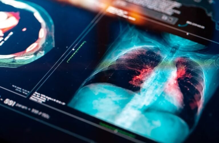 Cáncer de pulmón: aprobaron un tratamiento innovador que combina dos terapias