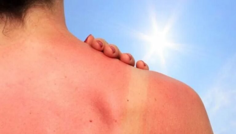 Recomendaciones para cuidar la piel durante el verano