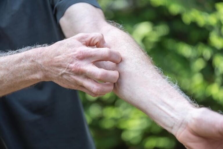 Fue al hospital por una picadura y le diagnosticaron una grave enfermedad