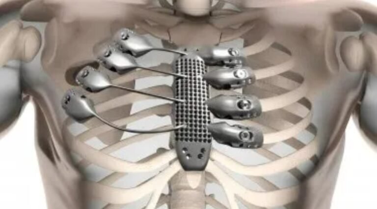 Avance científico: un hospital realizó cirugías con implantes 3D