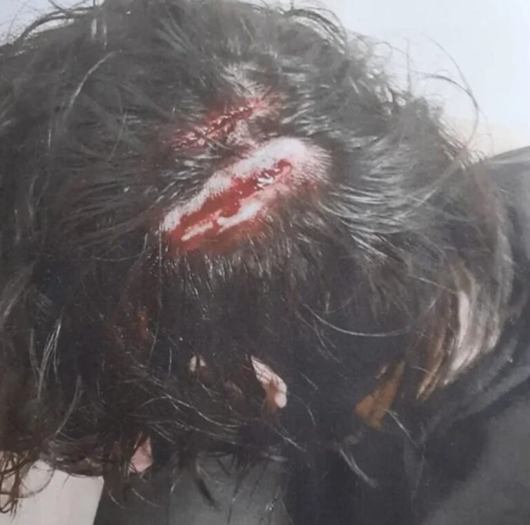 Un estudiante atacó con un fierro a su compañero y le provocó graves heridas en la cabeza