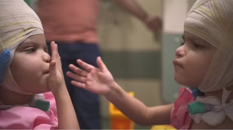 Lograron separar a dos siamesas que estaban unidas por el cráneo tras una cirugía de 27 horas