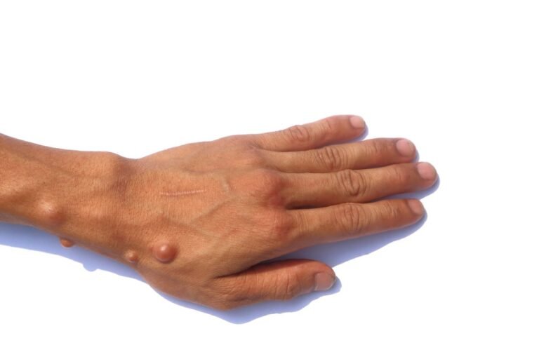 Día Mundial de la neurofibromatosis: la importancia de la visibilización