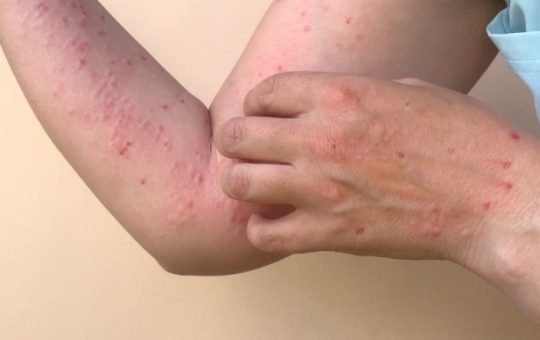 Hay un caso sospechoso de Viruela del Mono: “Es una enfermedad muy contagiosa”