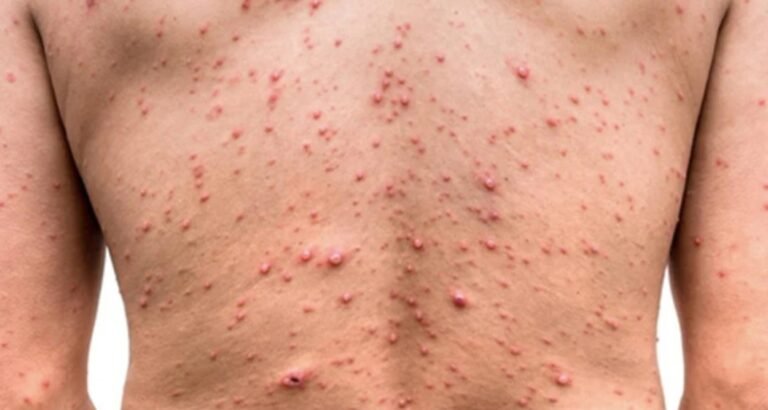 Viruela del mono en Argentina: confirman el primer caso autóctono