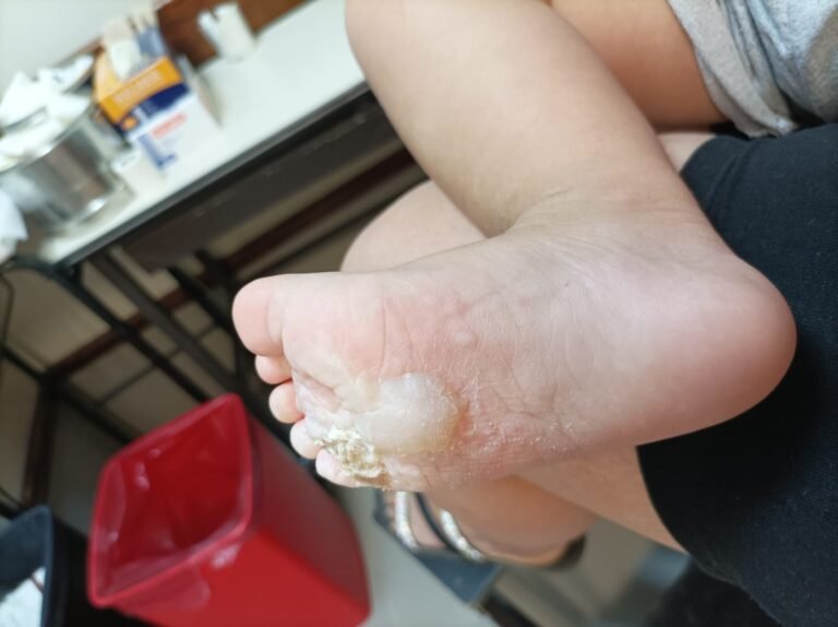 Una familia se fue de la playa sin apagar las brasas y su hijo se quemó el pie