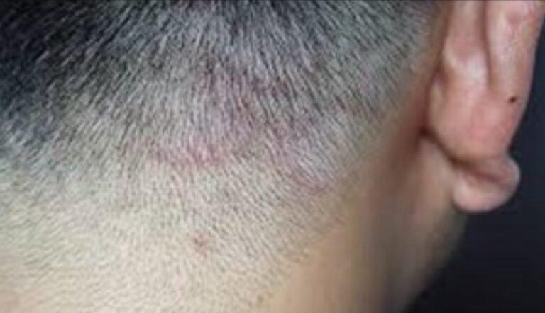 La “tiña de barbería” aumenta por falta de esterilización en las peluquerías