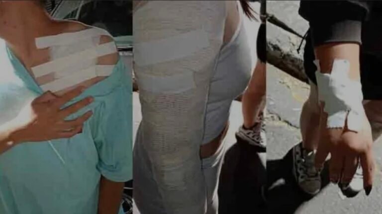 Falló una máquina de humo en un boliche y hubo varios quemados