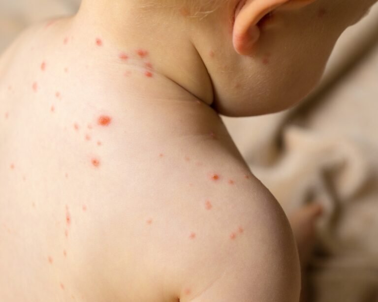 Alerta epidemiológica ante la confirmación de un caso de sarampión