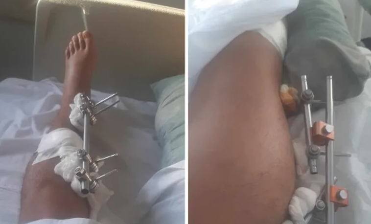 Una camioneta lo chocó, lo dejó abandonado y ahora estará un año sin trabajar