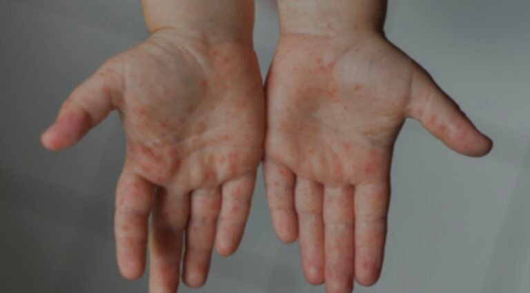 Sarampión: la Organización Panamericana de la Salud advierte que hay diez veces más casos que el año pasado