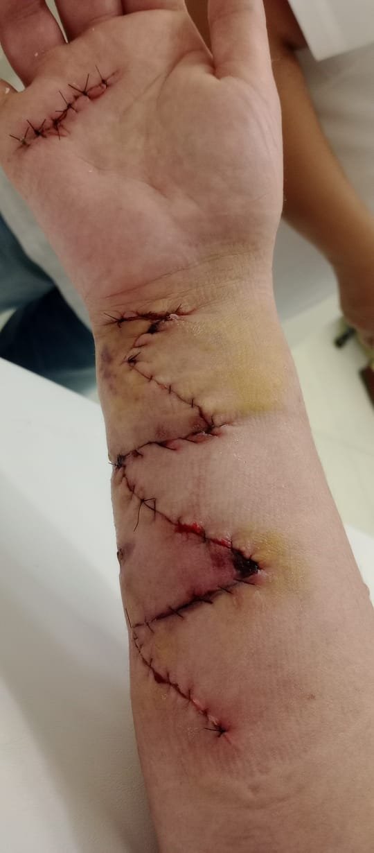 Una mujer denuncia brutal ataque del perro de una amiga en Ciudadela: “Me dejaron tirada”