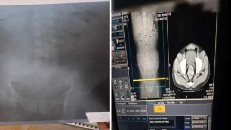 Una “mula” intoxicada con drogas fue trasladada de urgencia al hospital