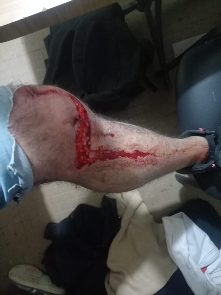 “Si agarran a una criatura la matan”: la palabra del hombre atacado por dogos en Km. 8