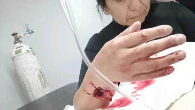 Salió a correr y la atacó el pitbull de un adiestrador: le fracturó un brazo y tuvieron que operarla