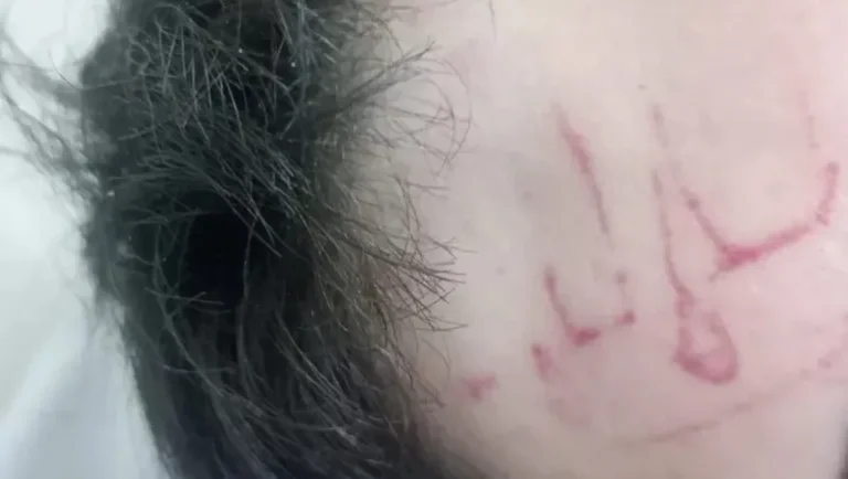 Día del Amigo salvaje: le pegaron entre cinco y le dejaron la marca de una zapatilla en la cara