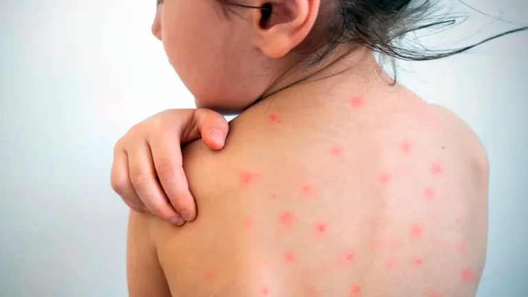 Sarampión en Argentina: sube la preocupación por nuevos casos confirmados
