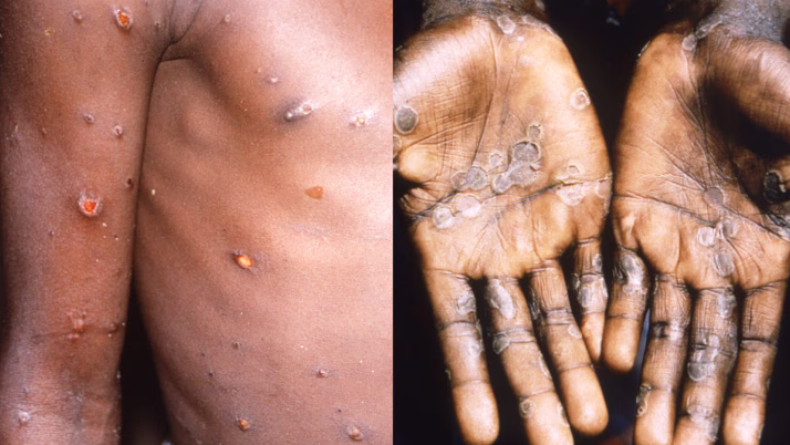 Confirman el primer caso de una variante más contagiosa de viruela del mono en Argentina