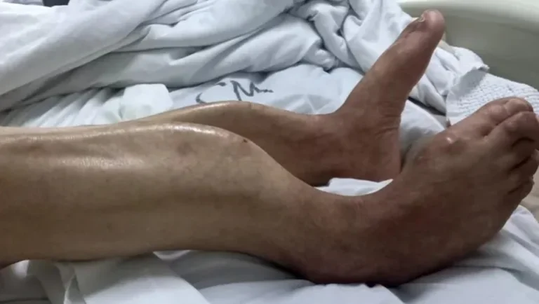 Insólito: fue al doctor por un dolor abdominal y descubrieron que tiene “piernas de sable”